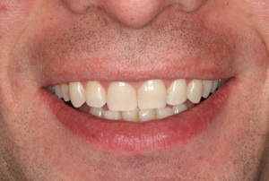 Smile after Invisalign