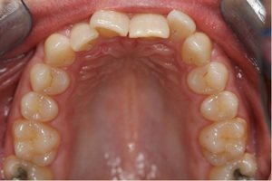 Crooked teeth before Invisalign