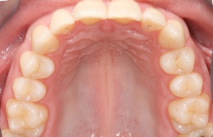 Actual view of completed Invisalign case