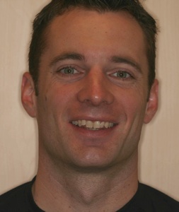 Before smile of our Invisalign Patient