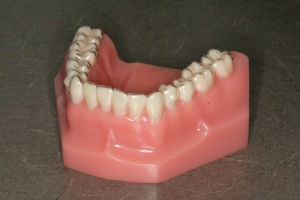 Invisalign aligner on the model
